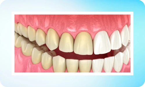 Boc-su-cho-rang-o-vang