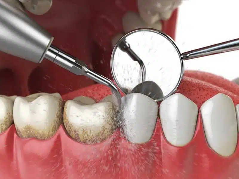 cao-voi-rang-la-gi-1