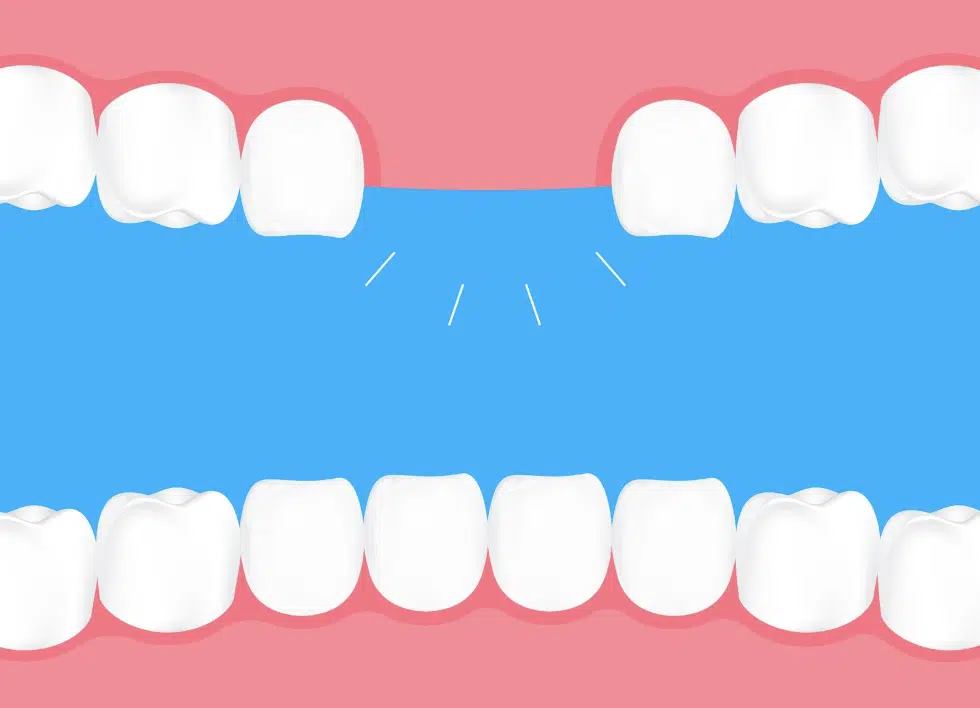 Cấy ghép Implant dành cho những ai?