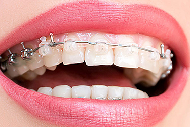 nho-rang-khi-can-chinh-nha