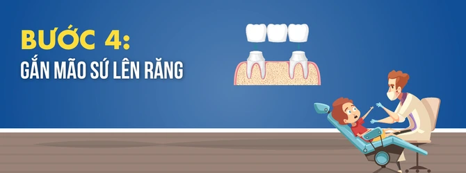quy-trinh-boc-rang-su-4
