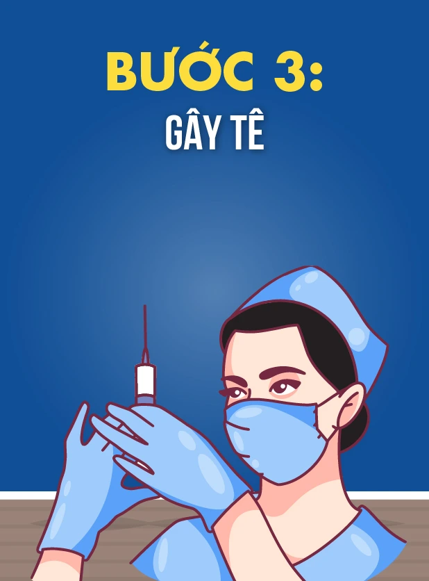 quy-trinh-tram-rang-3