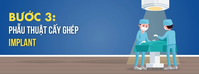 quy-trinh-trong-rang-implant-3