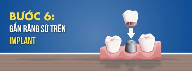 quy-trinh-trong-rang-implant-6
