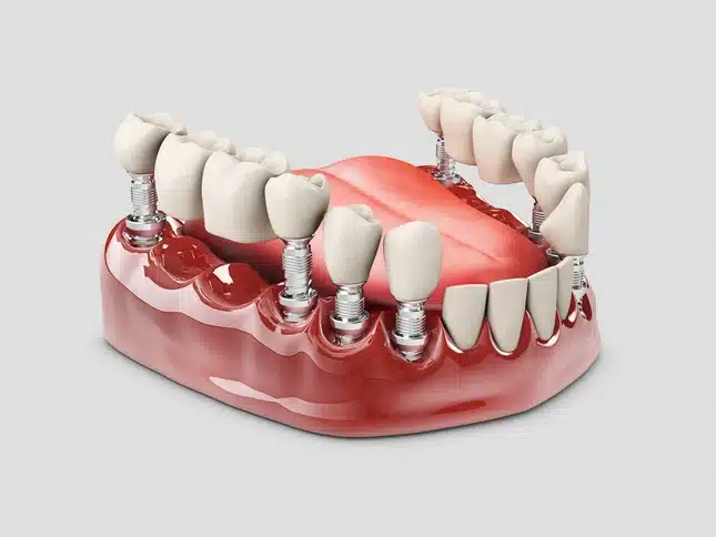 rang-gia-lap-tren-tru-implant