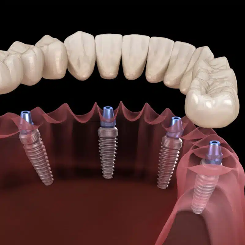 Trồng răng Implant là gì? Cấy ghép Implant dành cho những ai?