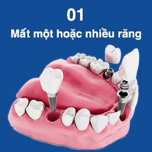 doi-tuong-lam-rang-implant-1