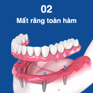 doi-tuong-lam-rang-implant-2