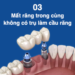 doi-tuong-lam-rang-implant-3