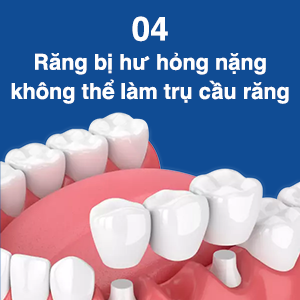 doi-tuong-lam-rang-implant-4
