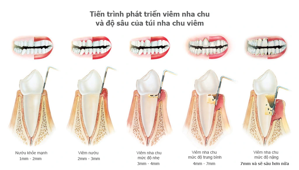 tien-trien-cua-benh-viem-nha-chu-1